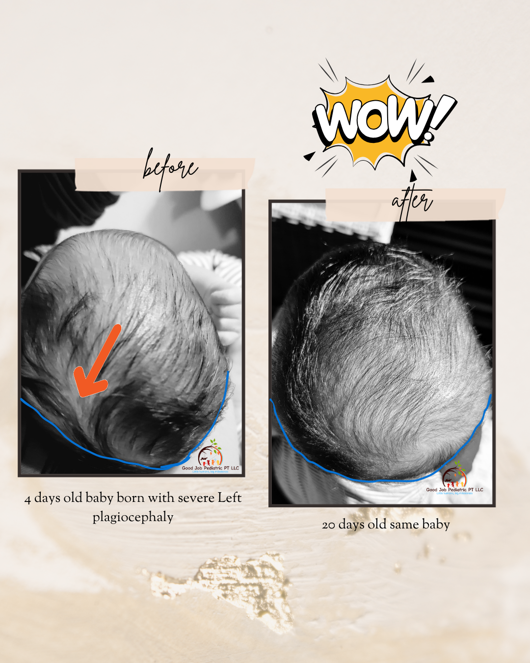 flathead/ plagiocephaly correction, without helmet before and after in a 4 day old baby