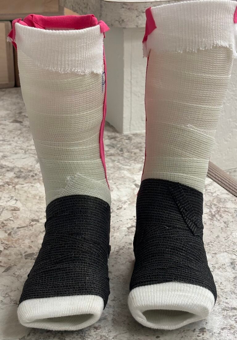 Dynamic Flex cast